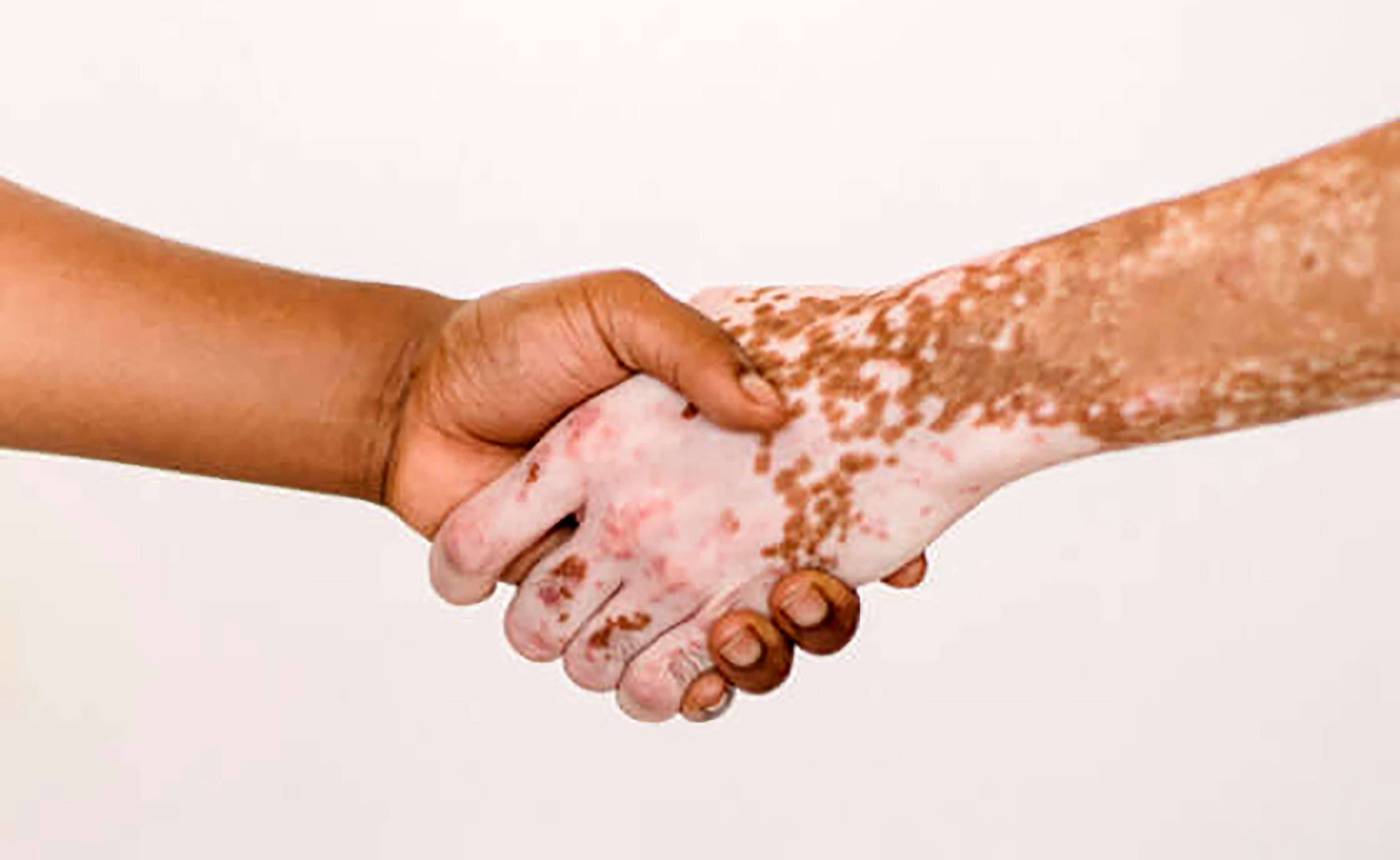 Día Mundial del Vitiligo: 2 a 6% de mexicanos lo padece