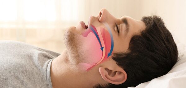 Estudio identifica el primer tratamiento farmacológico para la apnea del sueño