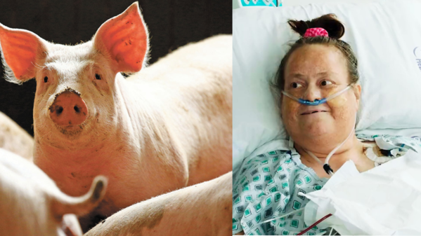 Murió la mujer que recibió un trasplante de riñón de un cerdo