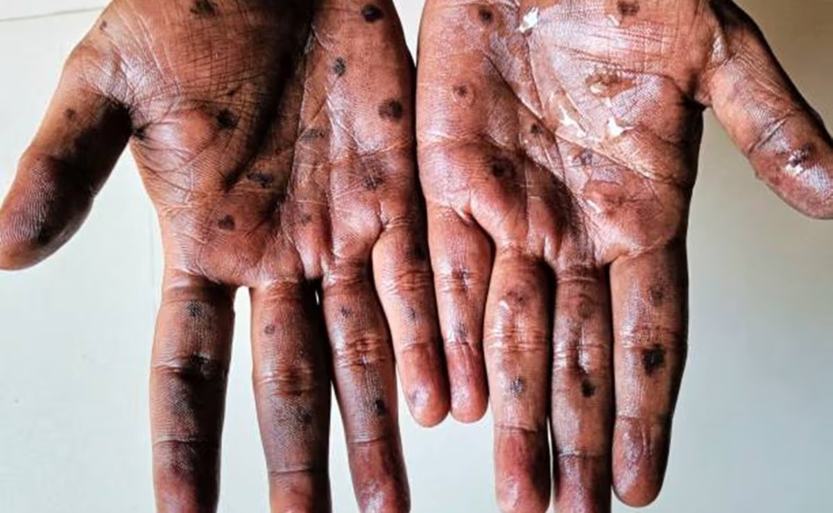 El Brote de viruela de mono origen zoonótico y expansión internacional