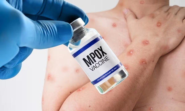 Piden aumentar producción de vacunas contra viruela del mono para frenar propagación