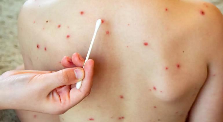 Confirman mil 926 casos de sarampión en México