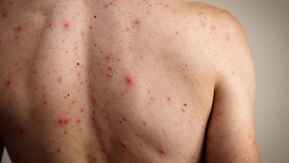 Hemos contenido brotes de sarampión, particularmente Chihuahua: David Kershenobich