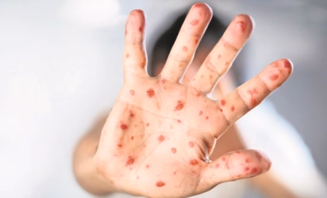 OPS afirma que persiste el brote de sarampión en México