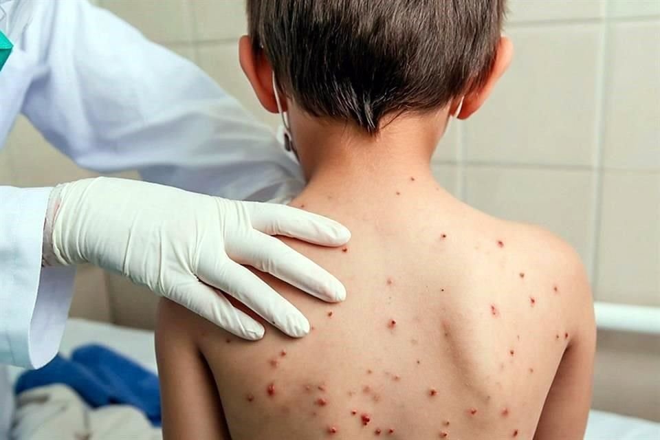 Secretaría de Salud reporta 74 casos activos de sarampión en nueve estados del país