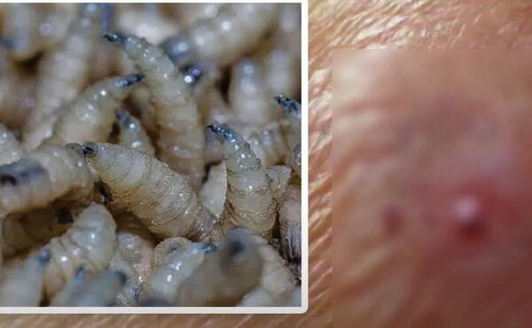 Registran séptimo contagio humano de miasis por gusano barrenador en Yucatán