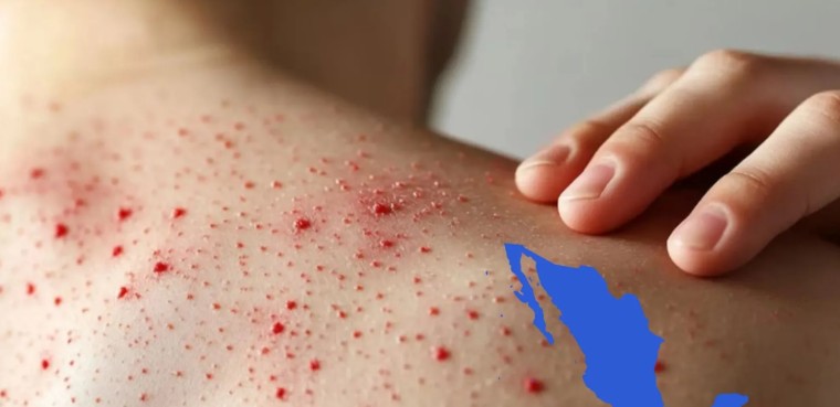 Confirma Salud la primera muerte de sarampion en 2026