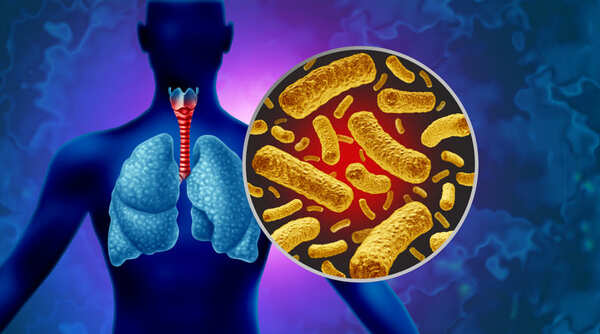 Aumentan los casos de tosferina en Yucatán