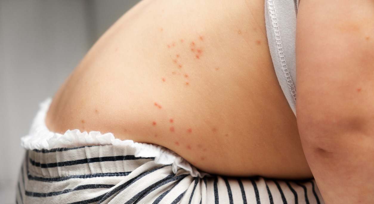 Chiapas rebasa los mil 600 casos de sarampión al inicio de 2026