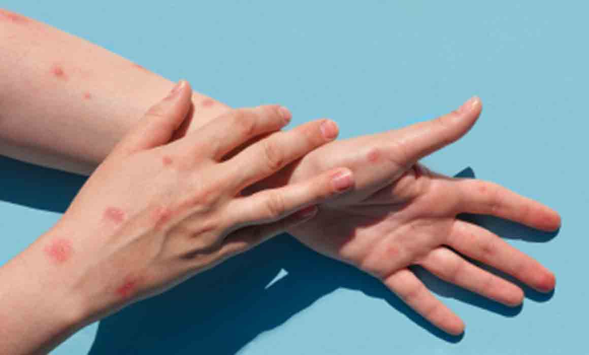 Alerta sanitaria: paciente alemán trae viruela símica a México