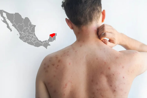 Sarampión repunta: 9 contagios en Yucatán