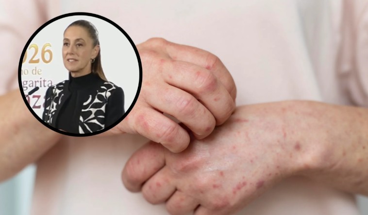 México pide mantener «la calma» ante brote de sarampión y refuerza vacunación infantil