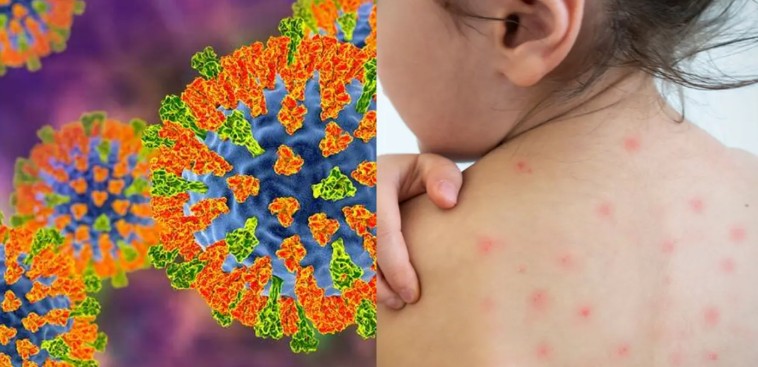 México acumula 9 mil 351 casos de sarampión