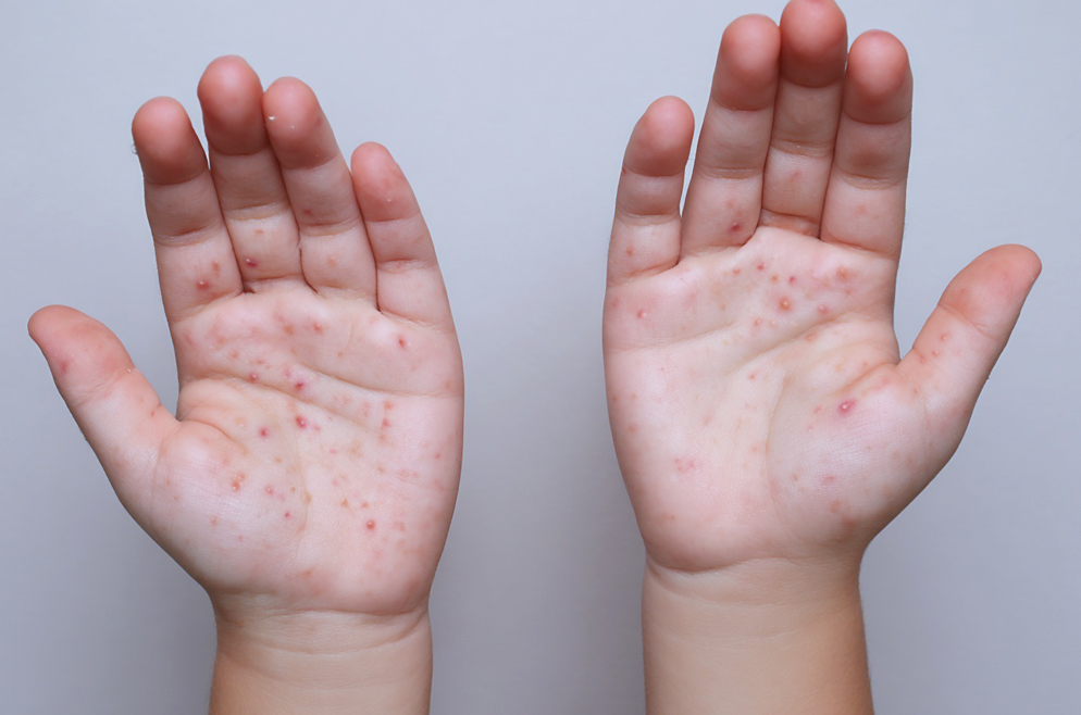 La OPS emite alerta ante el aumento de casos de sarampión en las Américas